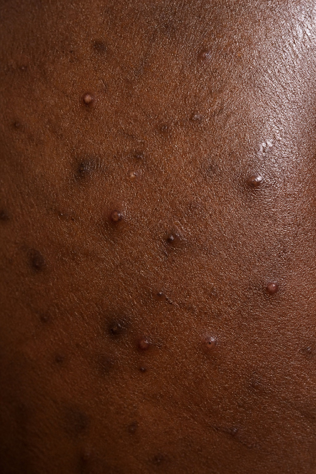 Close-up texture associated with body acne